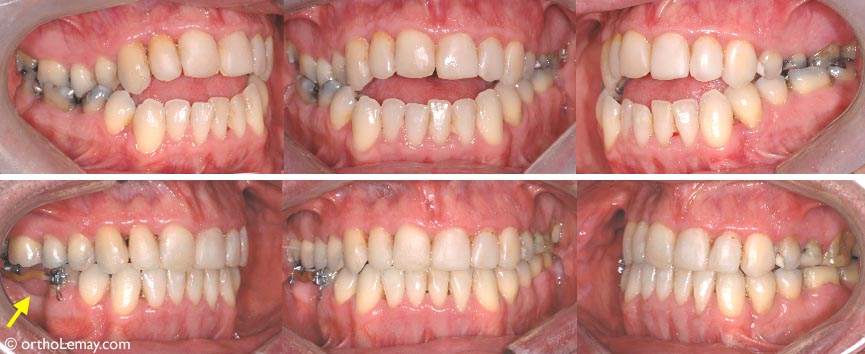 Après le traitement, les dents antérieures se touchent et sont plus fonctionnelles. Des boîtiers maintiennent l'espace inférieur où la dent a été extraite jusqu'à ce qu'elle soit remplacée par le dentiste. Durée du traitement : 23 mois.