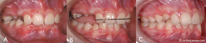 Surplomb vertical excessif entre les dents antérieures (A). Avec l'appareil (plan articulé), les dents postérieures ne se touchent plus et les dents antérieures du bas ne mordent plus au palais. Après plusieurs mois, les dents antérieures ne se recouvrent plus une fois l'appareil enlevé (C) 