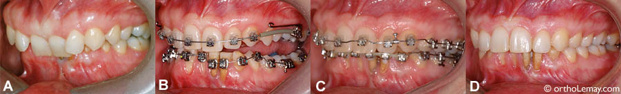 The guiding planes can also be sued during orthodontic corrections. It helps the teeth to become more visible during alignment. (A) Severe dental malocclusion (adult, 37 years of age) with excessive overbite of the anterior teeth. (B) With the appliance in the mouth. (C)" During the orthodontic corrections. (D) Final result; the teeth are well separated.