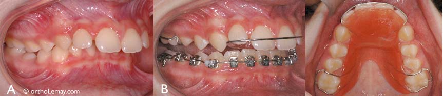 Bite plane and braces Orthodontist Lemay Sherbrooke Sm 083276 The bite plane can also be used during orthodontic corrections to make teeth that present an overbite more visible and facilitate the corrections.