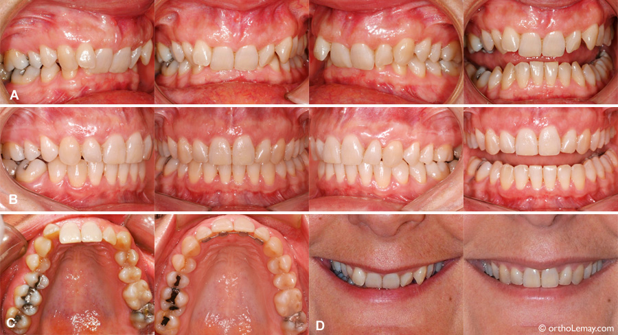 Correction of a Class II division 2 malocclusion adult in orthodontics.