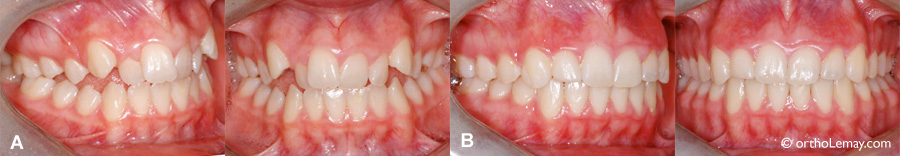 Béance postérieure, malocclusion corrigée en orthodontie.