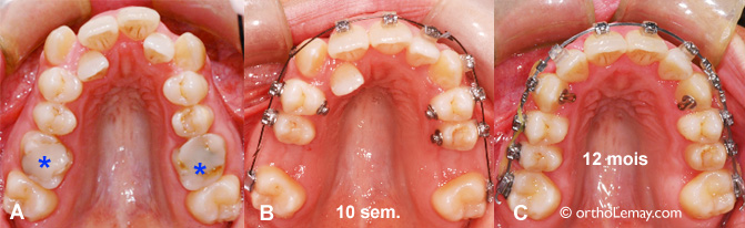 Expansion dentaire et extractions en orthodontie. Fermeture d'espace.