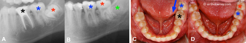 Extraction of a molar and recuperation of the wisdom tooth in orthodontics