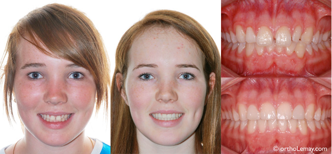 sourire orthodontie sherbrooke laterales elargies CL1 113218 VM14