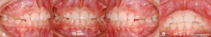 Progression de l'usure dentaire chez un enfant avec grincement de dents. Orthodontie