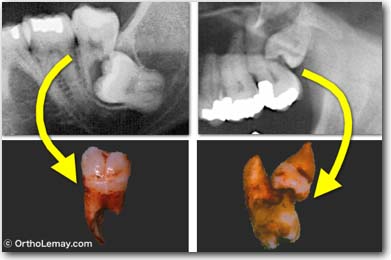 Exemples de dents de sagesse incluses (troisièmes molaires) qui ont poussé sous les deuxièmes molaires et ont résorbé les racines à un tel point que les deuxièmes et troisièmes molaires ont dues être extraites.