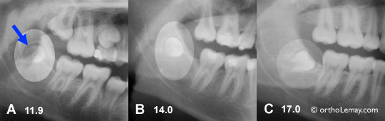 Eruption of a wisdom tooth that migrated forward.