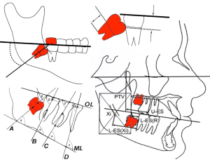 Prediction eruption wisdom orthodents dontist Lemay