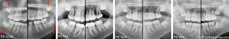 Wisdom teeth dent sagesse orthodontiste Lemay FC 971175