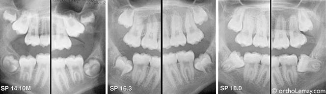 Wisdom teeth troisièmes molaires orthodontie Lemay SP