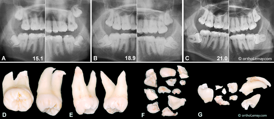 Évolution de la position des dents de sagesse inférieures pendant une période de 6 ans. Dès qu'il est évident que les dents ne sortiront pas convenablement, il serait préférable de les extraire pour éviter que l'intervention (extraction) soit plus complexe plus tard (pour le patient et le chirurgien).