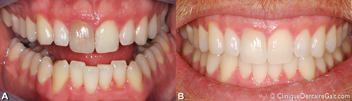 Exemple d'un blanchiment dentaire intra coronal fait par un dentiste pour une seule dent qui était décolorée