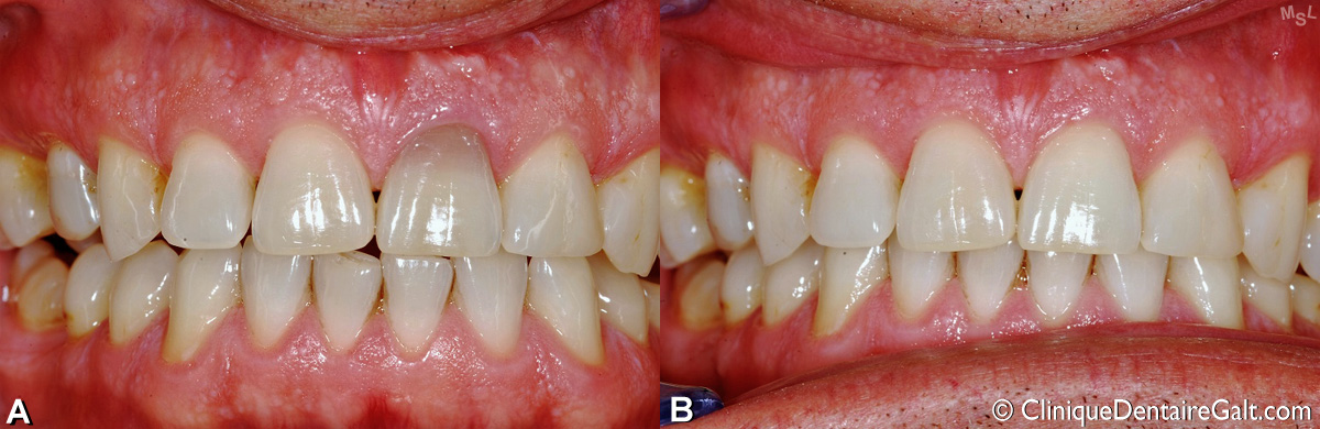 Autre exemple de blanchiment dentaire intracoronal pour une incisive supérieure décolorée