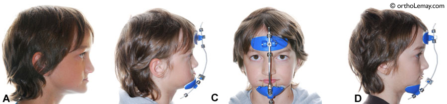 Utilisation ,un masque extra oral Delaire pour un traitement orthodontique 