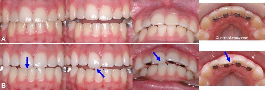 Coup reçu par une cheerleader. Les dents ont été déplacées. (A) Dentition telle qu'elle était à la fin du traitement d'orthodontie (bouche fermée et ouverte). (B) Lors d'une routine, cette "cheerleader" reçut un coup au visage qui a déplacé une centrale supérieure vers l'intérieur de sorte qu'elle peut plus fermer la bouche complètement. L'appareil de rétention collé aux dents a été déformé lors de l'impact mais a probablement empêché un déplacement plus important des dents. Un protecteur buccal aurait offert encore plus de protection. De nouvelles corrections seront nécessaire pour corriger ce déplacement dentaire. Suite à un tel impact, il est possible que la dent change de couleur.