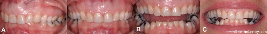 (A) Malocclusion avec surplomb antérieur vertical important; les incisives supérieures recouvrent complètement celles du bas. (B) La bouche ouverte montre l'usure importante des incisives inférieure. (D) Cette usure se produit lorsque la mâchoire inférieure est avancée pour permettre aux incisives de fonctionner ensemble.(Adulte- 53 ans)