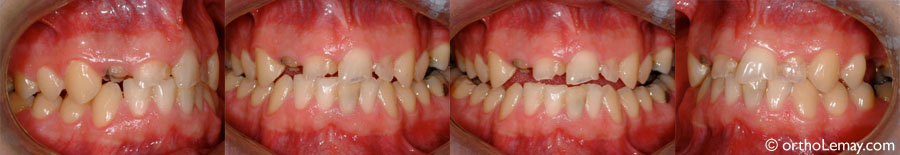 Usure dentaire adulte 093102JM Orthodontie Lemay