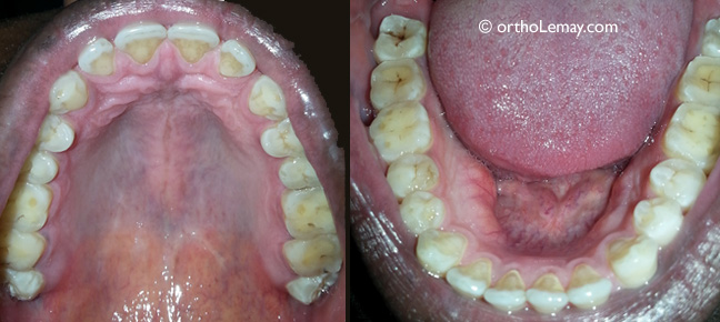 Usure dentaire avancée de l'émail et de la dentine causée par du bruxisme et grincement de dents.