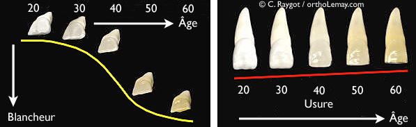 Usure dentaire et changement de couleur avec le temps.