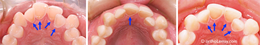 Érosion chimique des dents et boissons gazeuses