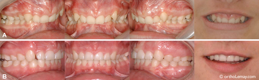 Classe 2 div 2 correction orthodontique Sherbrooke 043163DD
