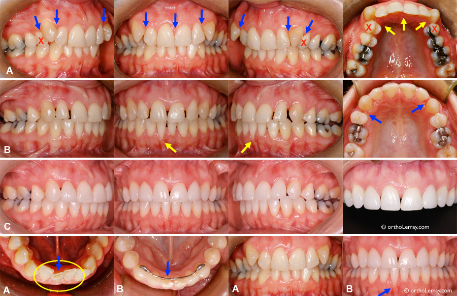 Correction de rotations dentaires en orthodontie et triangles noirs inesthétiques, perte de gencive.