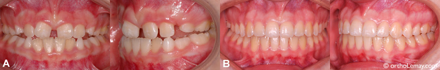 Correction orthodontique d'une malocclusion classe 3 chez un adolescent