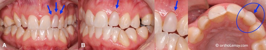 Inflammation gingivale chronique et restauration dentaire.
