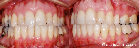 Élargissement de dents trop étroites suite à un traitement d'orthodontie. 