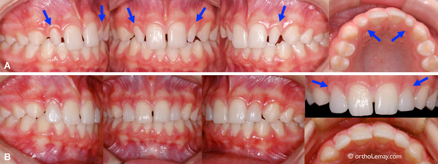 Latérales étroites élargies avant le traitement d'orthodontie.