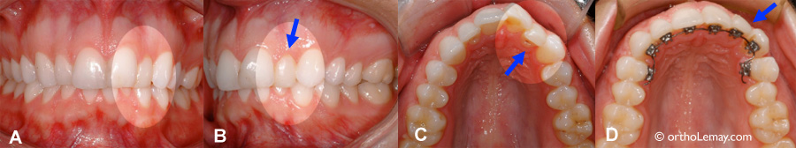 Facette dentaire en composite camouflant une dent reculée