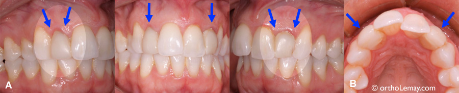 Irritation gingivale et inflammation causées par des facettes de composite.