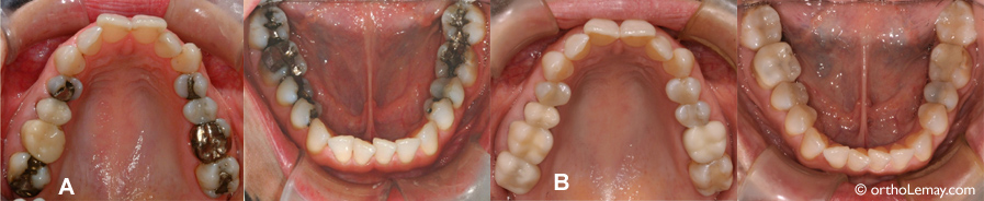 Exemples de changements de matériaux restauratifs dentaires.
