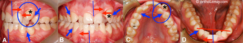 Extraction dent permanente sans traitement d'orthodontie 