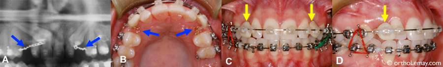 Traction of an impacted canine in orthodontics