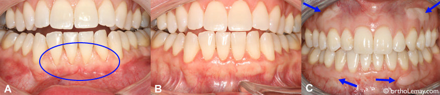 Gingival graft periodontics orthodontics Anterior lower gum (gingival) graft