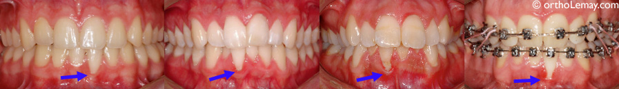 Récession gingivale et orthodontie