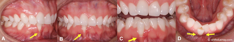 Relation entre une malocclusion et le parodonte