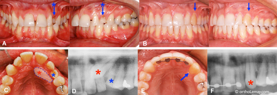 Canine incluse traitée en orthodontie chez un adulte. Orthodontiste Lemay Sherbrooke orthodontie par les orthodontistes Lemay