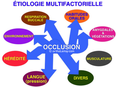 Cause et étiologie des malocclusions dentaires