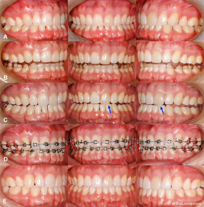 Utilisation d'une plaque occlusale (gouttière) pour aider des maux de tête.