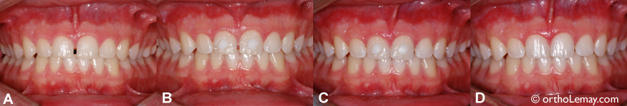 Fermeture d'un espace entre les dents supérieures en orthodontie