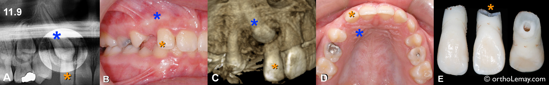 resorption usure racine canine incluse ectopique extraction orthodontie Sherbrooke BJ 540702 11_9