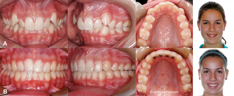 Correction malocclusion classe 1 avec chevauchement en orthodontie