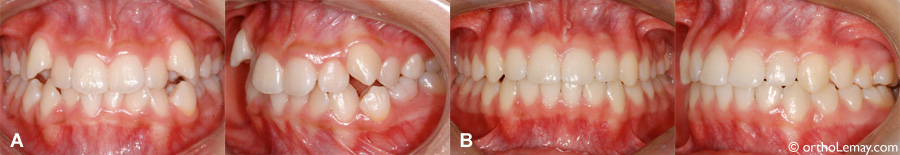 Malocclusion dentaire classe 1 avec chevauchement corrigée en orthodontie 