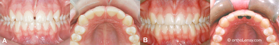 Fermeture d'un espace entre les dents avant enorthodontie