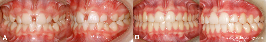 Fermeture d'un diastème entre des centrales en orthodontie