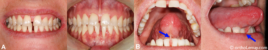 Langue et frein labial causant des espaces inter-dentaires