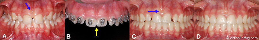 Frenum frein diastème orthodontie frenectomie